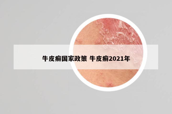 牛皮癣国家政策 牛皮癣2021年