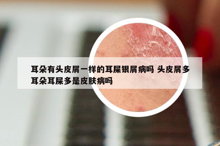 耳朵有头皮屑一样的耳屎银屑病吗 头皮屑多耳朵耳屎多是皮肤病吗
