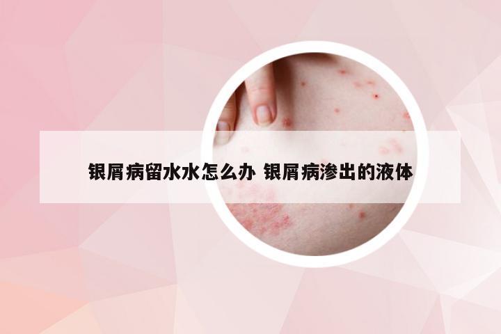 银屑病留水水怎么办 银屑病渗出的液体