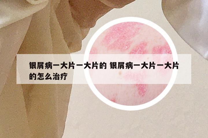 银屑病一大片一大片的 银屑病一大片一大片的怎么治疗