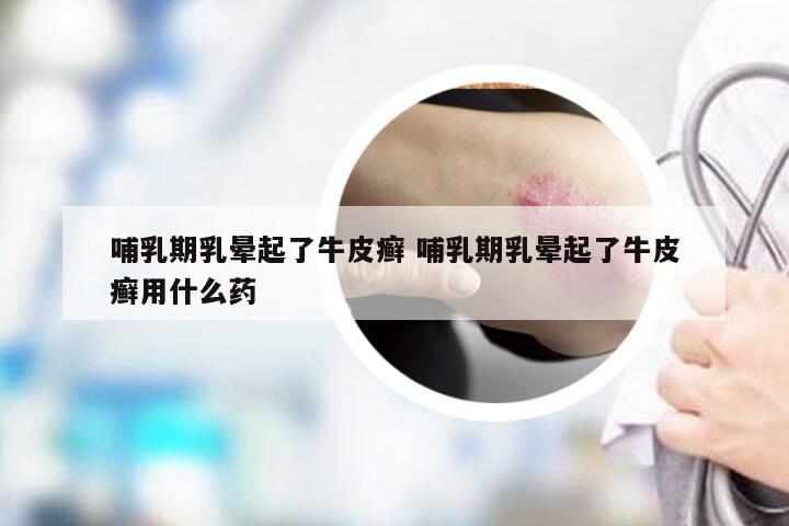 哺乳期乳晕起了牛皮癣 哺乳期乳晕起了牛皮癣用什么药