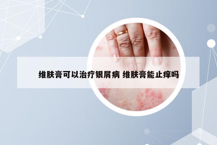 维肤膏可以治疗银屑病 维肤膏能止痒吗