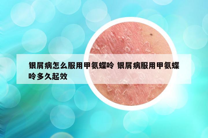 银屑病怎么服用甲氨蝶呤 银屑病服用甲氨蝶呤多久起效