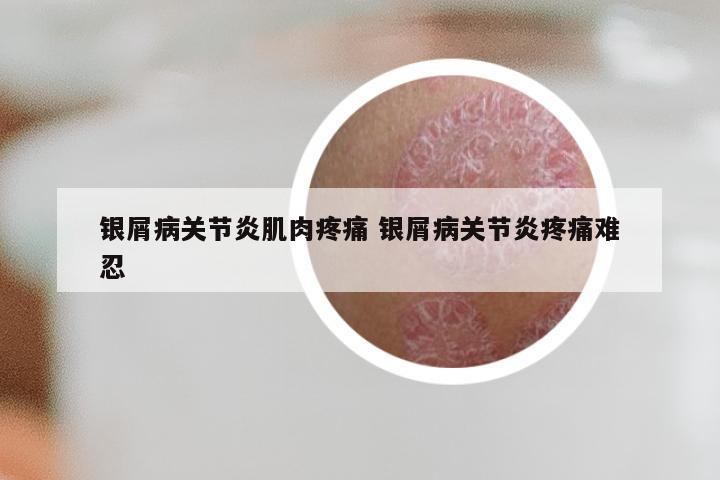 银屑病关节炎肌肉疼痛 银屑病关节炎疼痛难忍