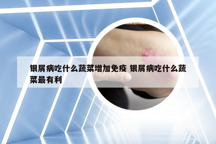 银屑病吃什么蔬菜增加免疫 银屑病吃什么蔬菜最有利