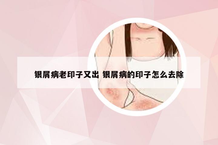 银屑病老印子又出 银屑病的印子怎么去除