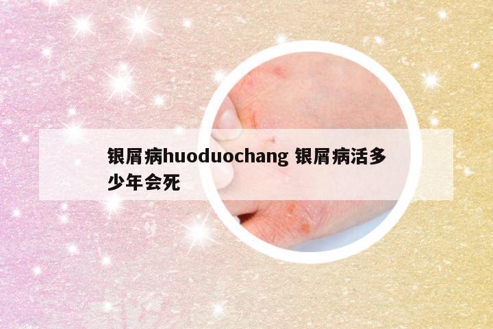 银屑病huoduochang 银屑病活多少年会死