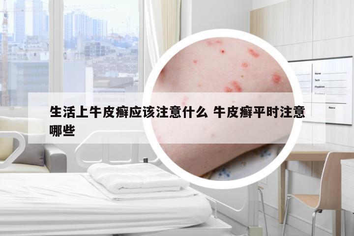 生活上牛皮癣应该注意什么 牛皮癣平时注意哪些