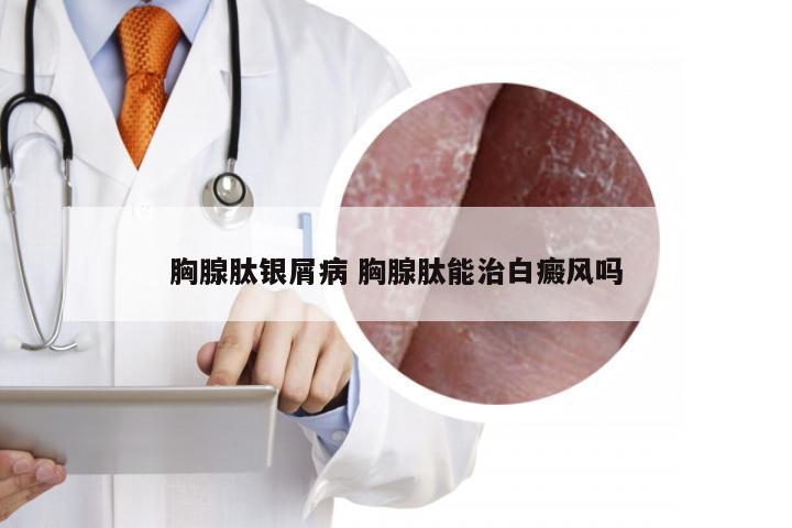 胸腺肽银屑病 胸腺肽能治白癜风吗