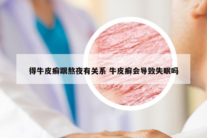 得牛皮癣跟熬夜有关系 牛皮癣会导致失眠吗