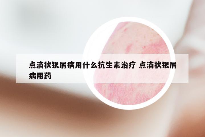 点滴状银屑病用什么抗生素治疗 点滴状银屑病用药