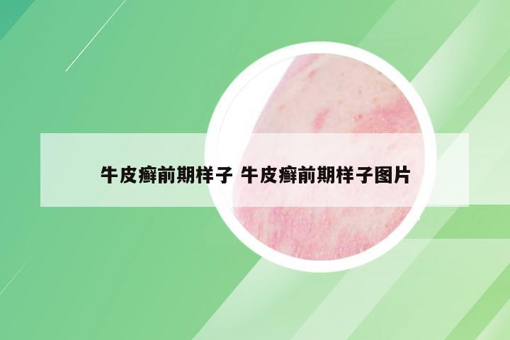 牛皮癣前期样子 牛皮癣前期样子图片