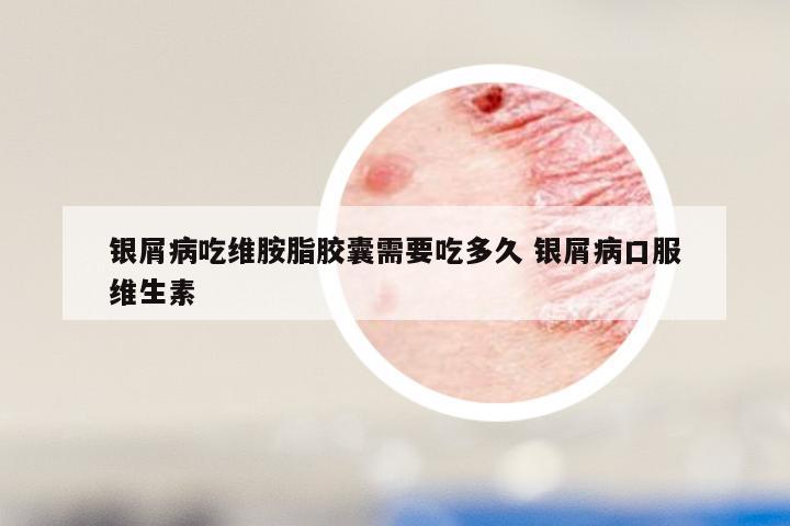 银屑病吃维胺脂胶囊需要吃多久 银屑病口服维生素