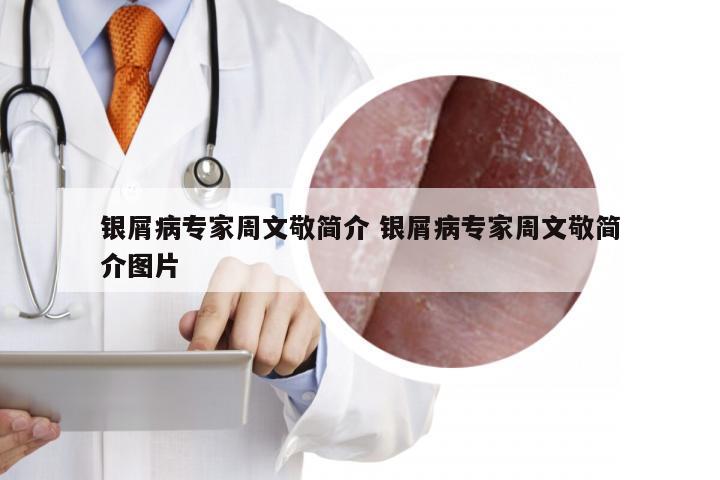 银屑病专家周文敬简介 银屑病专家周文敬简介图片