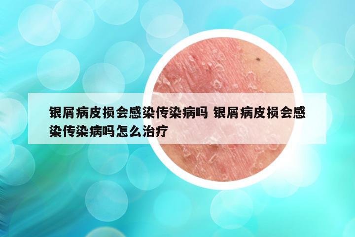 银屑病皮损会感染传染病吗 银屑病皮损会感染传染病吗怎么治疗