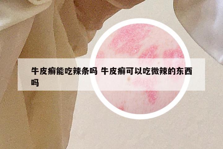 牛皮癣能吃辣条吗 牛皮癣可以吃微辣的东西吗