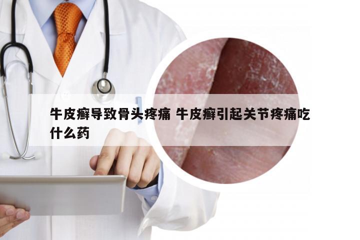 牛皮癣导致骨头疼痛 牛皮癣引起关节疼痛吃什么药