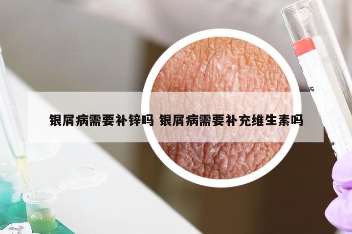 银屑病需要补锌吗 银屑病需要补充维生素吗