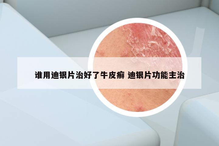 谁用迪银片治好了牛皮癣 迪银片功能主治