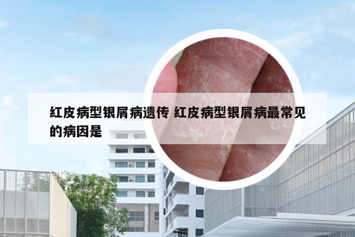 红皮病型银屑病遗传 红皮病型银屑病最常见的病因是