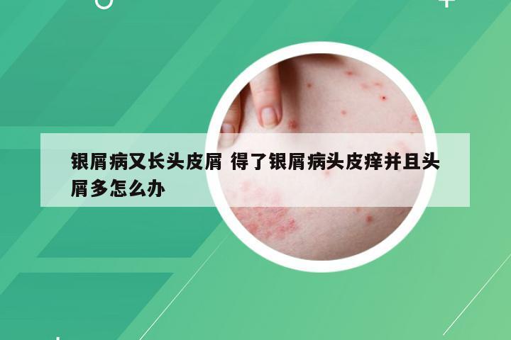 银屑病又长头皮屑 得了银屑病头皮痒并且头屑多怎么办