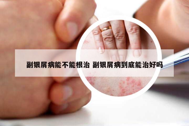 副银屑病能不能根治 副银屑病到底能治好吗