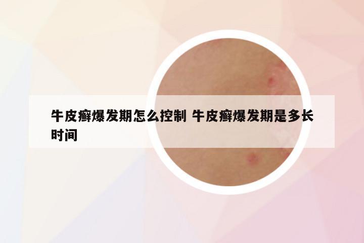 牛皮癣爆发期怎么控制 牛皮癣爆发期是多长时间