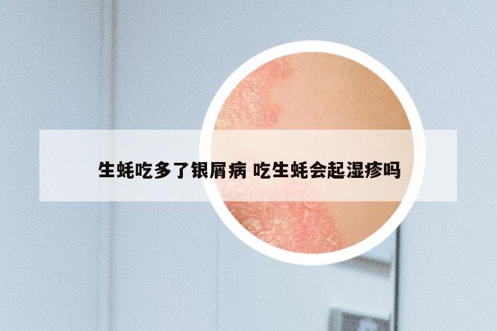 生蚝吃多了银屑病 吃生蚝会起湿疹吗