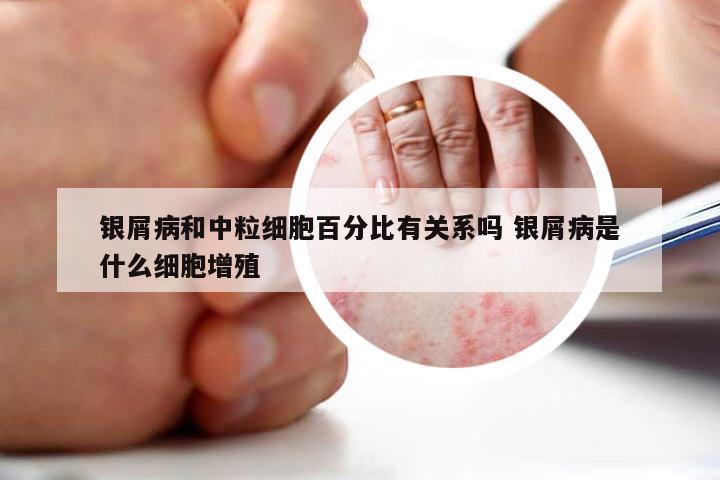 银屑病和中粒细胞百分比有关系吗 银屑病是什么细胞增殖