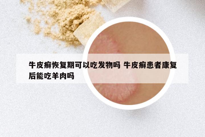 牛皮癣恢复期可以吃发物吗 牛皮癣患者康复后能吃羊肉吗