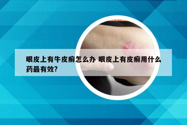 眼皮上有牛皮癣怎么办 眼皮上有皮癣用什么药最有效?