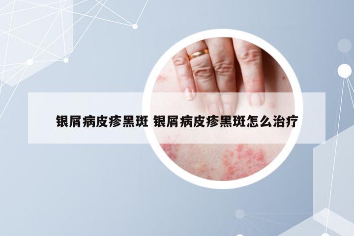 银屑病皮疹黑斑 银屑病皮疹黑斑怎么治疗