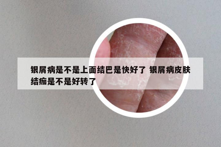 银屑病是不是上面结巴是快好了 银屑病皮肤结痂是不是好转了