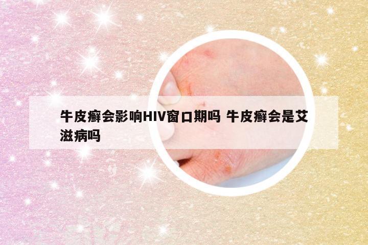 牛皮癣会影响HIV窗口期吗 牛皮癣会是艾滋病吗
