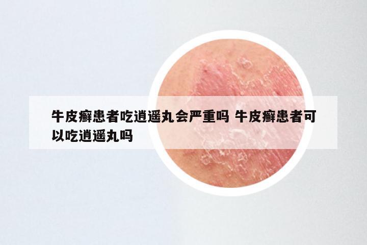 牛皮癣患者吃逍遥丸会严重吗 牛皮癣患者可以吃逍遥丸吗