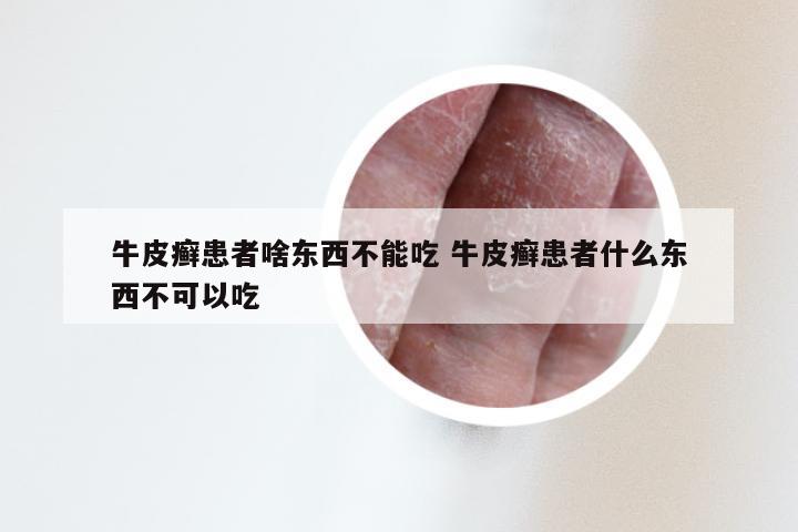 牛皮癣患者啥东西不能吃 牛皮癣患者什么东西不可以吃