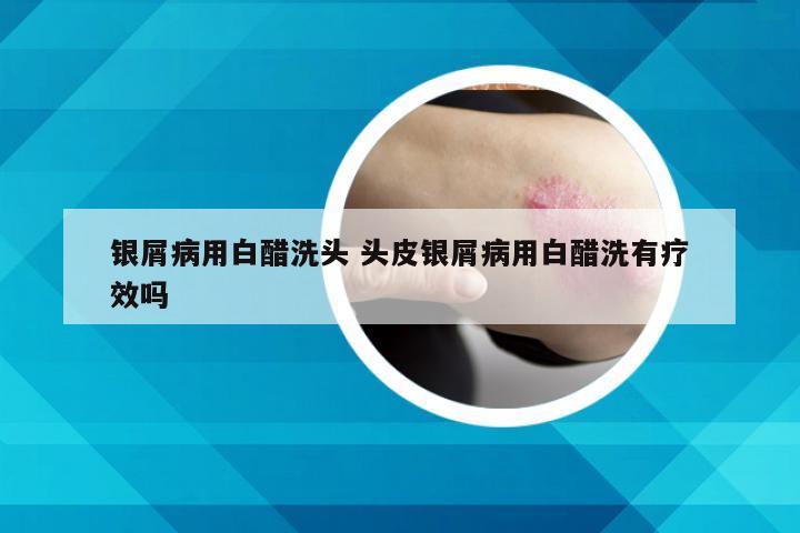 银屑病用白醋洗头 头皮银屑病用白醋洗有疗效吗