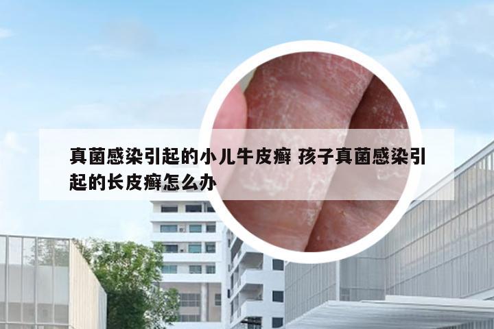 真菌感染引起的小儿牛皮癣 孩子真菌感染引起的长皮癣怎么办