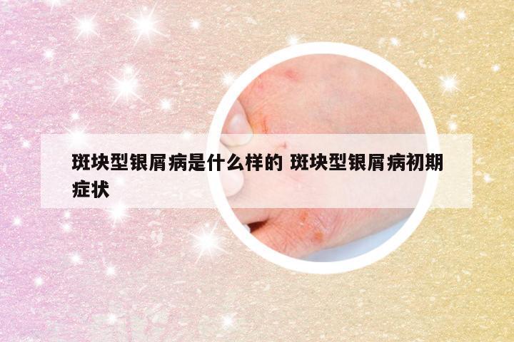 斑块型银屑病是什么样的 斑块型银屑病初期症状