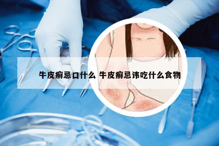 牛皮癣忌口什么 牛皮癣忌讳吃什么食物
