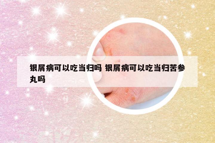 银屑病可以吃当归吗 银屑病可以吃当归苦参丸吗