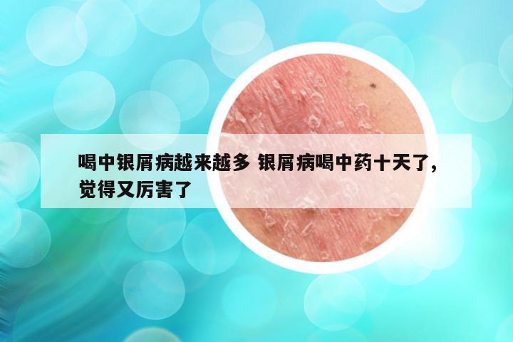 喝中银屑病越来越多 银屑病喝中药十天了,觉得又厉害了