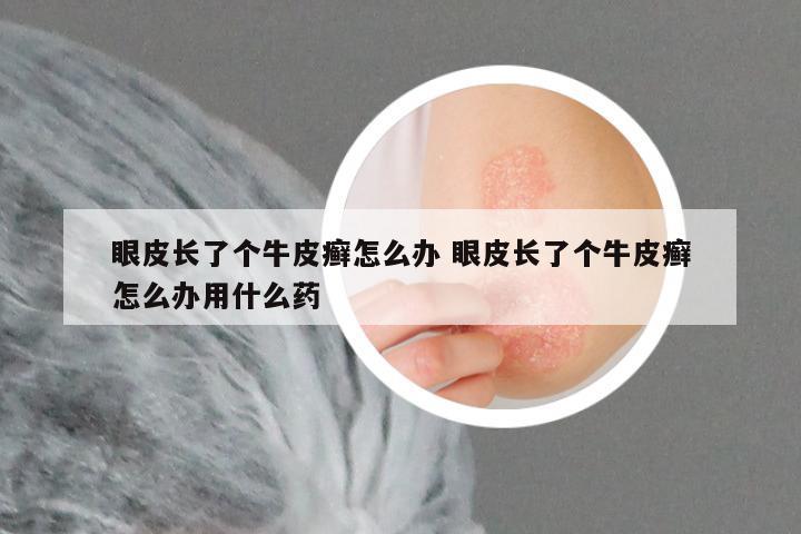 眼皮长了个牛皮癣怎么办 眼皮长了个牛皮癣怎么办用什么药