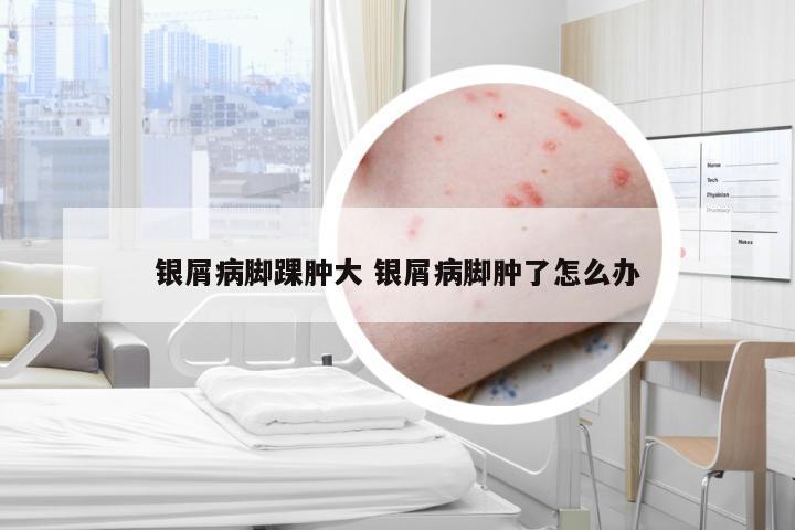 银屑病脚踝肿大 银屑病脚肿了怎么办