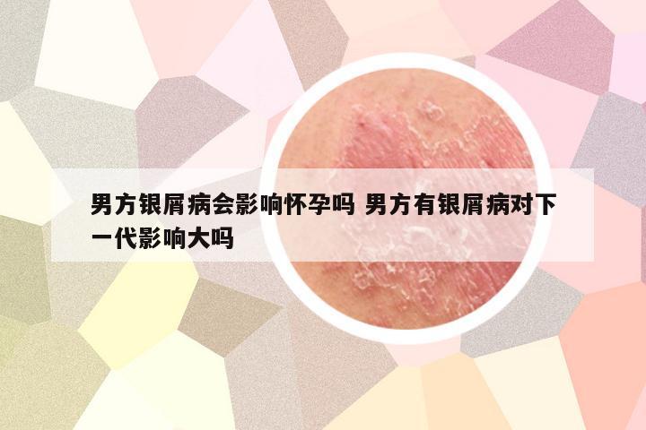 男方银屑病会影响怀孕吗 男方有银屑病对下一代影响大吗