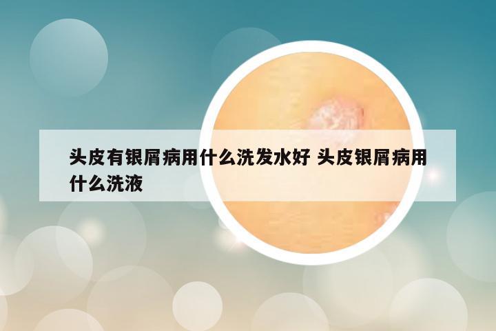 头皮有银屑病用什么洗发水好 头皮银屑病用什么洗液