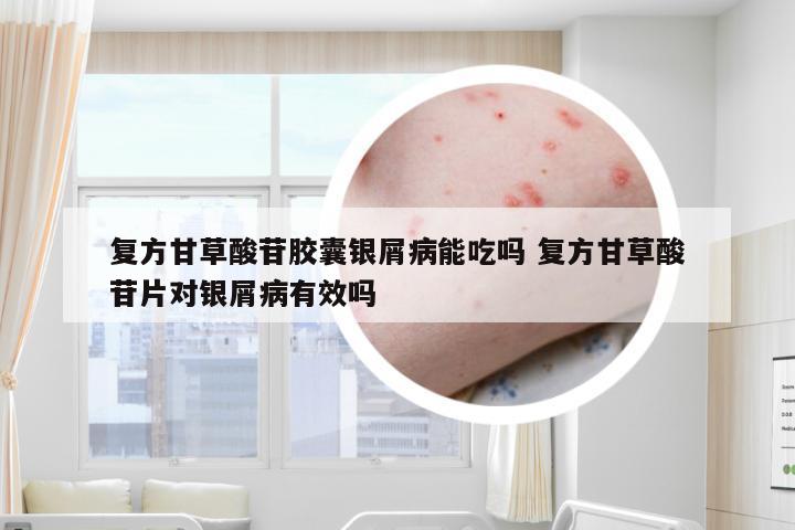 复方甘草酸苷胶囊银屑病能吃吗 复方甘草酸苷片对银屑病有效吗