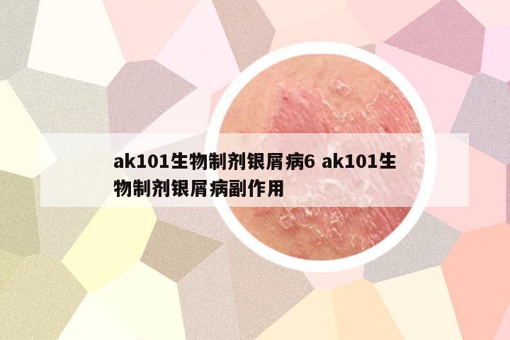 ak101生物制剂银屑病6 ak101生物制剂银屑病副作用