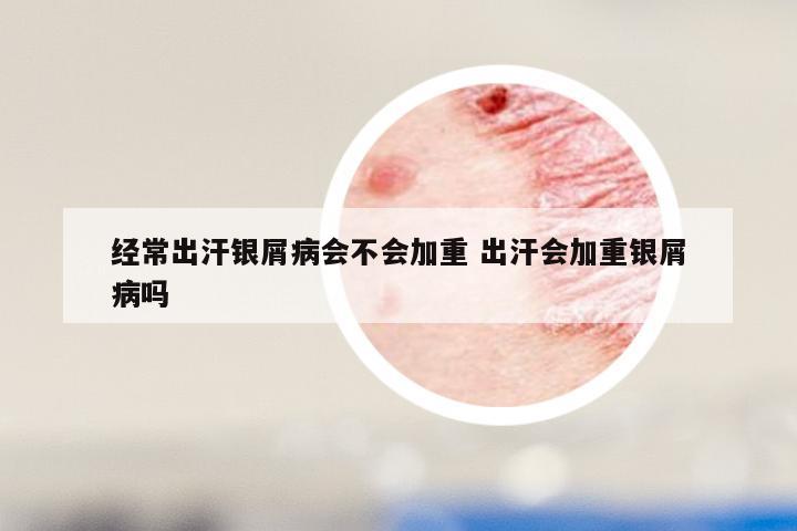 经常出汗银屑病会不会加重 出汗会加重银屑病吗