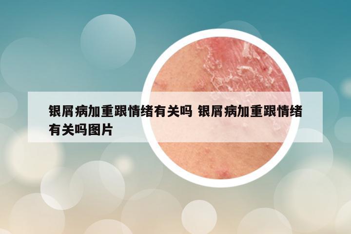银屑病加重跟情绪有关吗 银屑病加重跟情绪有关吗图片